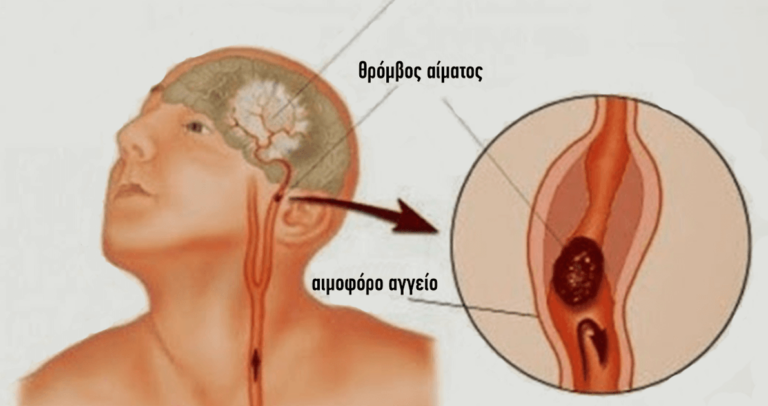 Tι κάνουμε σε ένα εγκεφαλικό – Παίρνει μόνο ένα λεπτό για να το διαβάσετε