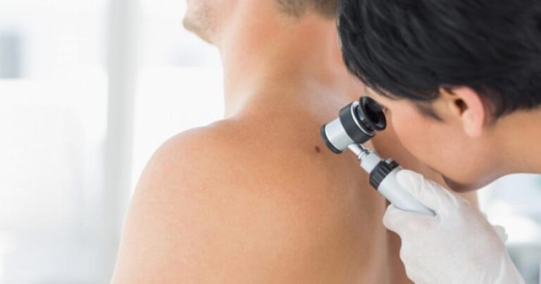 Βασικοκυτταρικό καρκίνωμα: Τα 5 προειδοποιητικά σημάδια