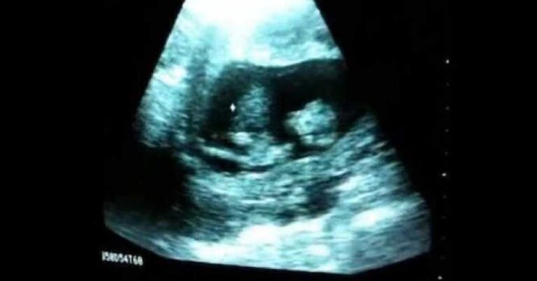 Αυτό το μωρό ακόμη δεν έχει γεννηθεί και ήδη έχει τρελάνει τους γονείς του! Δείτε το βίντεο…