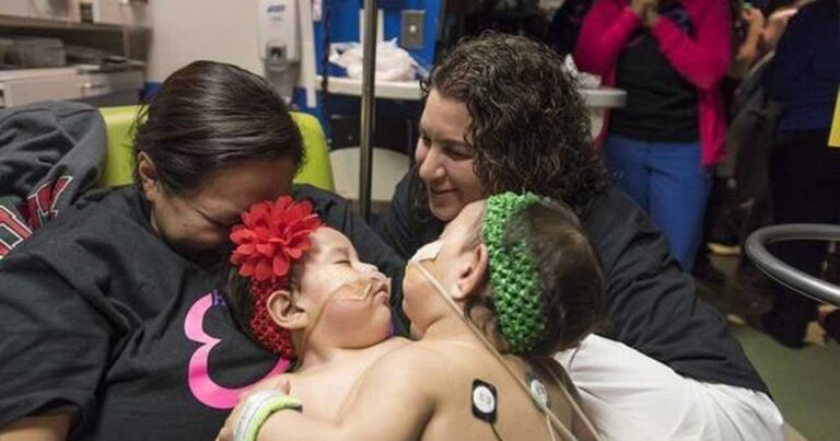 Δείτε την συγκλονιστική εγχείριση για τον διαχωρισμό σιαμαίων που κράτησε 26 ώρες.