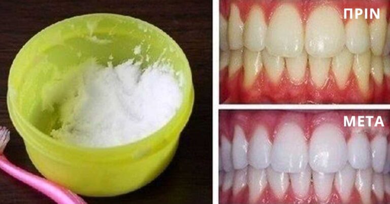 Μπορείς να λευκάνεις τα δόντια σου με φυσικό τρόπο χρησιμοποιώντας μόλις 2 υλικά που έχεις στο ντουλάπι σου!