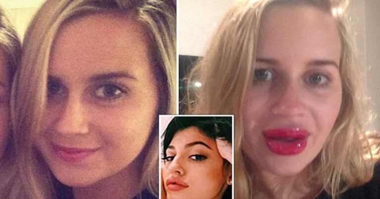 Γυναίκα φούσκωσε τα χείλη της με ειδική συσκευή για να μοιάσει… στην Kardashian!