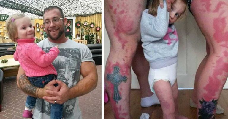 Γονείς έκαναν τατουάζ το σημάδι της γέννας που έχει η κόρη τους για να μην νοιώθει άσχημα!