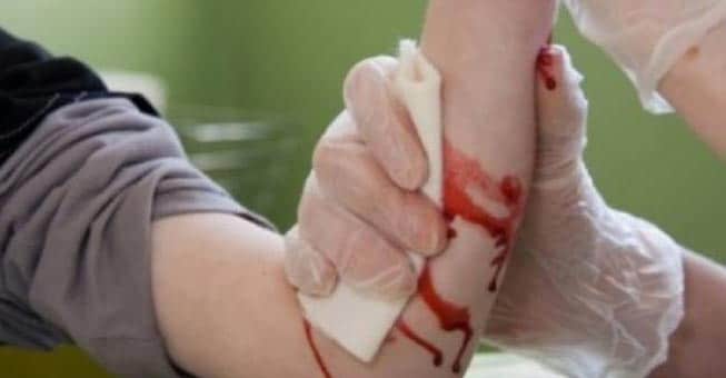Τι κάνουμε σε περίπτωση αρτηριακής αιμορραγίας; (βίντεο)