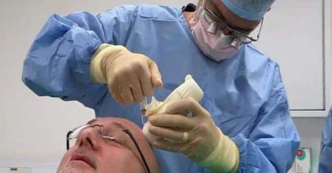 Δείτε το αποτέλεσμα μιας αποτυχημένης εμφύτευσης μαλλιών