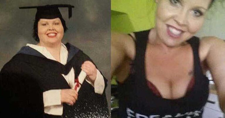 Εικόνες γυναίκας μετά από την εγχείρηση αφαίρεσης περιττού δέρματος