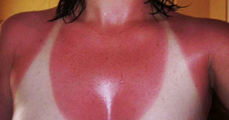 22 απίστευτα καψίματα που θα σας κάνουν να φοβάστε τον ήλιο!