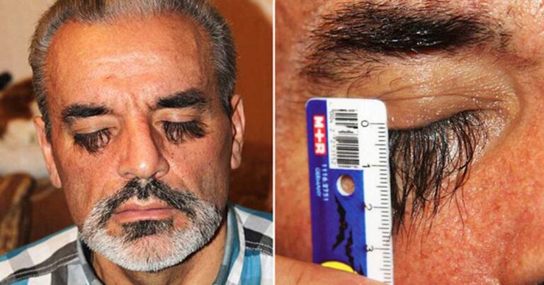 Ο Ουκρανός που έχει τις μακρύτερες βλεφαρίδες στο κόσμο επειδή τρώει ένα μυστικό φαγητό!