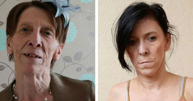 Η 18χρονη που μοιάζει για 50άρα λόγο σπάνιας πάθησης. Έκανε το πρώτο της λίφτινγκ στα 16.