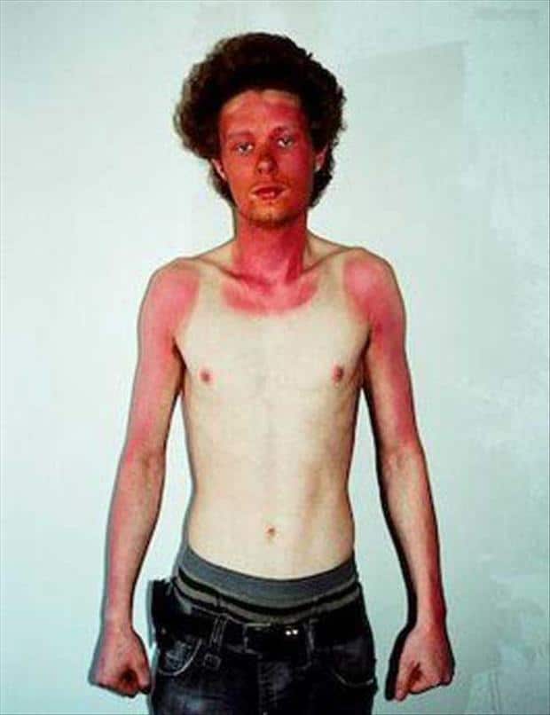 funny-sunburn-4