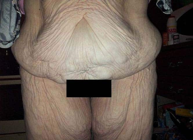 Γυναίκα αποκαλύπτει το σώμα της πριν και μετά την επέμβαση αφαίρεσης περίσσιου δέρματος (2)