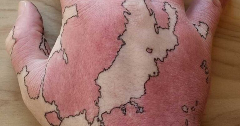 Mετέτρεψε το εκ γενετής σημάδι στο χέρι του σε χάρτη!