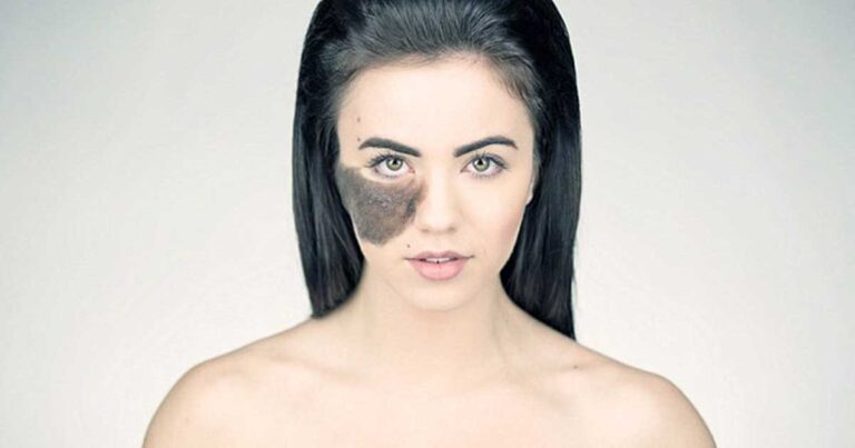 Η όμορφο κοπέλα με το τριχωτό σημάδι εκ γενετής που αγάπησε την ιδιαιτερότητα της και έγινε χορεύτρια