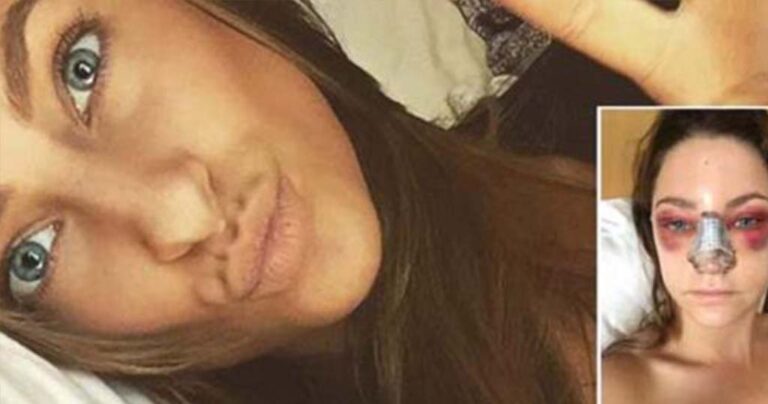 Έκανε πλαστική στη μύτη και μοιράστηκε τις εικόνες με όλους τους φίλους της στα social media!