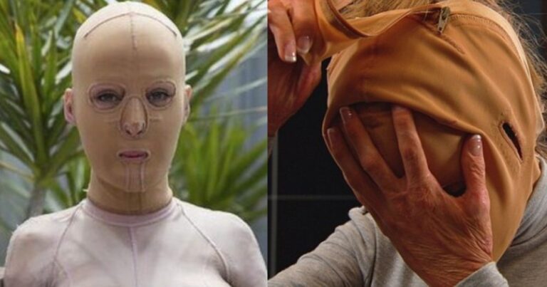 Γυναίκα μανιακός της έβαλε φωτιά, 2 χρόνια αργότερα βγάζει τη μάσκα και δείχνει το νέο της πρόσωπο