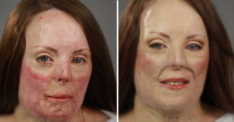 Το πρόσωπο της κάηκε σε τροχαίο. Δείτε όμως πως την βοήθησε το μακιγιάζ.