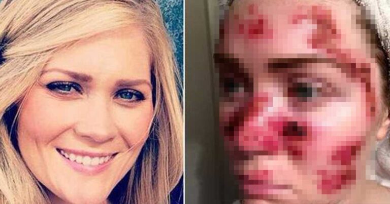 Σοκαριστική selfie: Δείτε πως έγινε το πρόσωπό της μετά από σολάριουμ