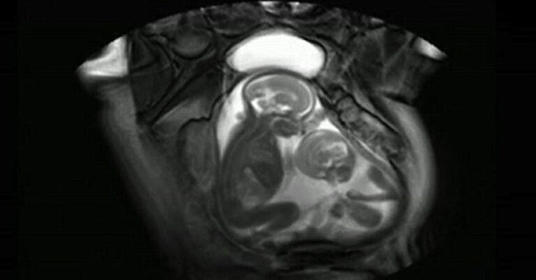 Δίδυμα μαλώνουν μέσα στη κοιλιά της μητέρας τους για το χώρο. Δείτε το απίστευτο βίντεο!