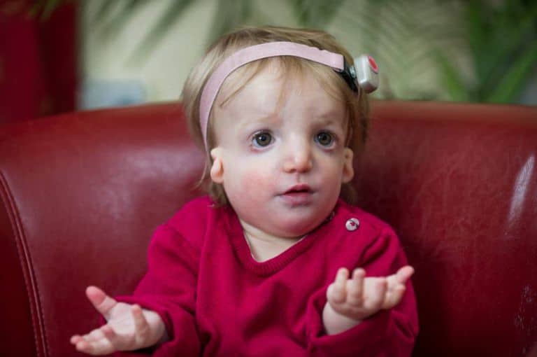 Alice Moore, 13 months who was born with the rare disease Treacher Collins Syndrome. See MASONS story MNFACE: A new dad with a severe facial disfigurement has defended his decision to have a baby daughter with the same condition. Simon Moore, 30, who is also profoundly deaf, has always been bullied and would hide indoors to avoid the stares of strangers.  His life changed when his hearing dog Foggy, introduced him to Vicky, 36, at a sign language class five years ago and the pair married in 2012. They wanted a family so started IVF and made the decision to keep baby Alice when tests showed she also had the condition known as Treacher Collins Syndrome (TC). They had been offered a special IVF process which included state-of-the-art preimplantation genetic diagnosis to screen for the TC gene that Simon carried. The treatment would search for and destroy any embryos that carried the faulty gene. But after speaking to their family they opted for traditional IVF because they feared the screening process could leave them with no embryos.