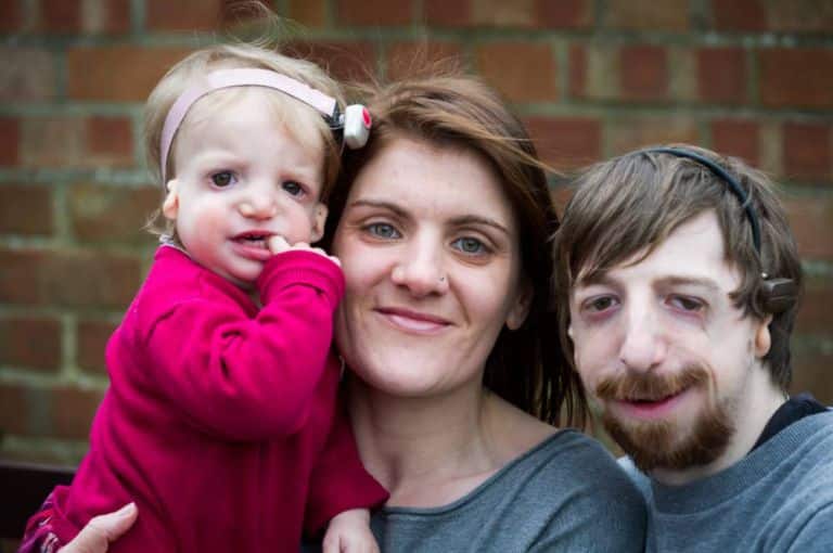 Alice Moore, 13 months who was born with the rare disease Treacher Collins Syndrome - her father Simon Moore, 30 also has the disease. Simon's wife Vicky Moore, 36 had IVF treatment to help conceive Alice as they so wanted to start a family together. See MASONS story MNFACE: A new dad with a severe facial disfigurement has defended his decision to have a baby daughter with the same condition. Simon Moore, 30, who is also profoundly deaf, has always been bullied and would hide indoors to avoid the stares of strangers.  His life changed when his hearing dog Foggy, introduced him to Vicky, 36, at a sign language class five years ago and the pair married in 2012. They wanted a family so started IVF and made the decision to keep baby Alice when tests showed she also had the condition known as Treacher Collins Syndrome (TC). They had been offered a special IVF process which included state-of-the-art preimplantation genetic diagnosis to screen for the TC gene that Simon carried. The treatment would search for and destroy any embryos that carried the faulty gene. But after speaking to their family they opted for traditional IVF because they feared the screening process could leave them with no embryos.