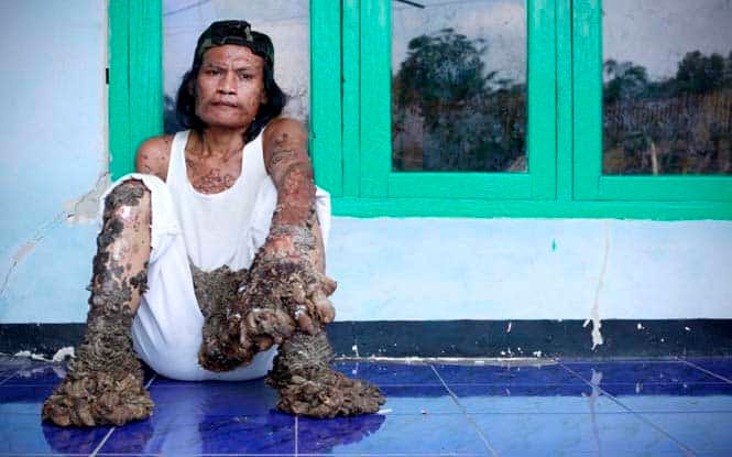 BANDUNG, WEST JAVA, INDONESIA - DECEMBER 18:  Indonesian man Dede Koswara sits outside his home on December 18, 2009 in Bandung, Java, Indonesia. Due to a rare genetic problem with Dede?s immune system he has been unable to fight the HPV infection or Human Papilloma Virus causing his body to produce tree like warts mostly on his arms and legs. Dede?s family including his two children have supported him while he has suffered with the debilitating virus. Following a diagnosis by US doctor Dr Anthony Gaspari, Dede has been able to start treatment for the warts which will improve his quality of life.  (Photo by Ulet Ifansasti/Getty Images)