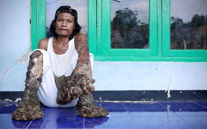 BANDUNG, WEST JAVA, INDONESIA - DECEMBER 18:  Indonesian man Dede Koswara sits outside his home on December 18, 2009 in Bandung, Java, Indonesia. Due to a rare genetic problem with Dede?s immune system he has been unable to fight the HPV infection or Human Papilloma Virus causing his body to produce tree like warts mostly on his arms and legs. Dede?s family including his two children have supported him while he has suffered with the debilitating virus. Following a diagnosis by US doctor Dr Anthony Gaspari, Dede has been able to start treatment for the warts which will improve his quality of life.  (Photo by Ulet Ifansasti/Getty Images)