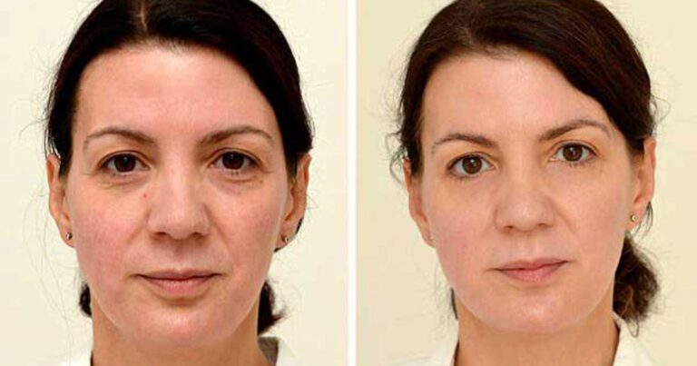 Δείτε την αλλαγή 42χρονης, που έπινε 3 λίτρα νερό την ημέρα, για 1 μήνα.