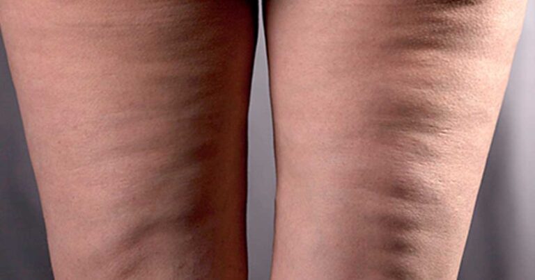 H απόλυτη σπιτική συνταγή κατά της κυτταρίτιδας! Υπόσχεται να βελτιώσει την εικόνα σας σε ένα μήνα.