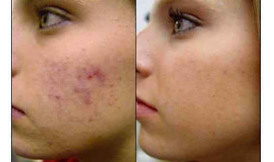 home-acne-tretament