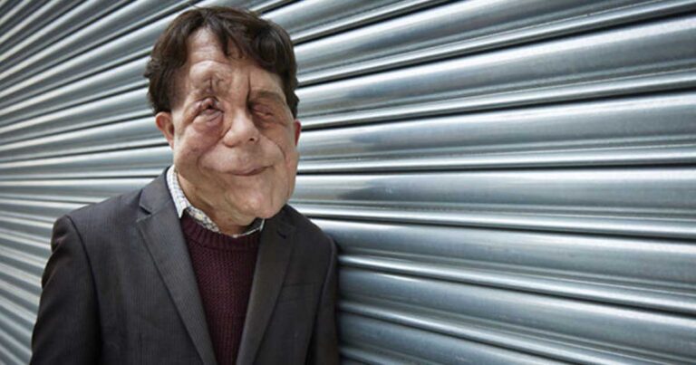 Η ιστορία του «ανθρώπου ελέφαντα»: Ο άνδρας που πάσχει από μια σπάνια ασθένεια.