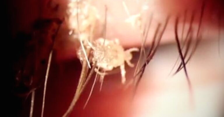 H γυναίκα νόμιζε πως είχε μόλυνση στο μάτι αλλά ήταν κάτι πολύ πιο τρομακτικό!