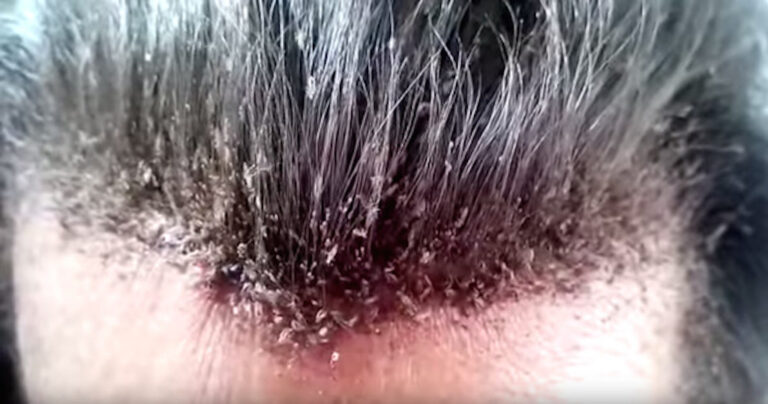 Άφησε το κεφάλι του γεμάτο ψείρες. Μόλις το δείτε θα θέλετε να πλυθείτε 5 φορές!