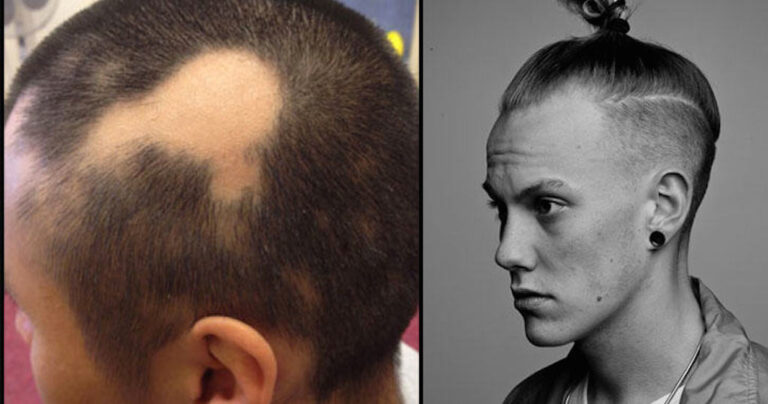 Χίπστερς προσοχή! Η κοτσίδα μπορεί να σας κάνει φαλάκρα!