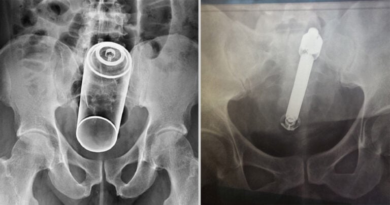 20 παράξενα αντικείμενα που έχουν βρεθεί μέσα σε… πισινούς!