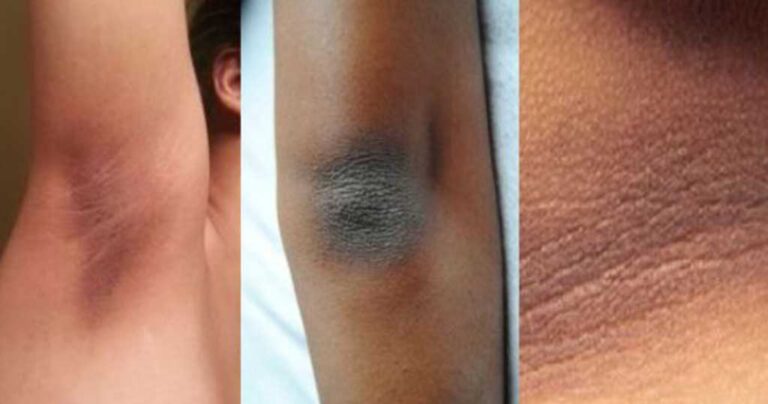 Οδηγίες για το μαυρισμένο δέρμα στους αγκώνες, το λαιμό, τα γόνατα και τη μασχάλη