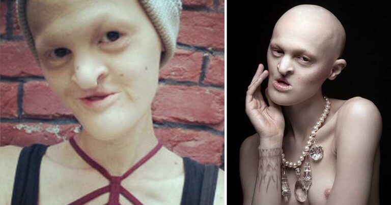 Την κορόιδευαν για χρόνια επειδή δεν είχε μαλλιά και δόντια, αν δείτε όμως που έχει φτάσει σήμερα…