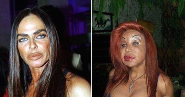 Περιπτώσεις που οι αισθητικές επεμβάσεις πάνε στραβά