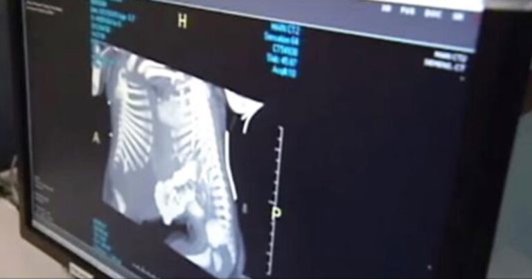 Σιαμαία μωρά επιβιώνουν μετά τον διαχωρισμό τους, παρά τις ελάχιστες πιθανότητες.