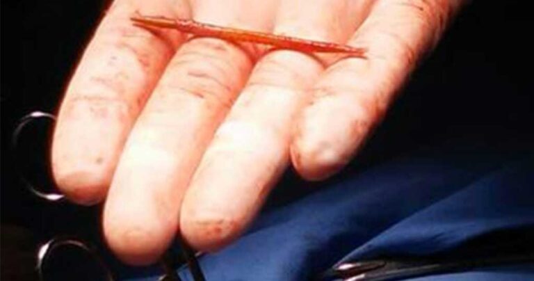 Ζούσε 2 χρόνια με μια οδοντογλυφίδα στην καρδιά!