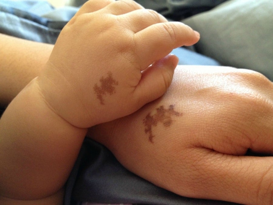 405305-R3L8T8D-900-birthmarks