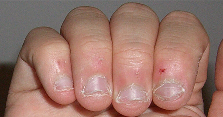 11 πράγματα που θα σας σταματήσουν από το να τρώτε τα νύχια σας