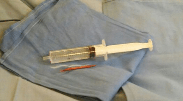 mans-stabbing-pain-caused-by-toothpick-accidentally-swallowed3