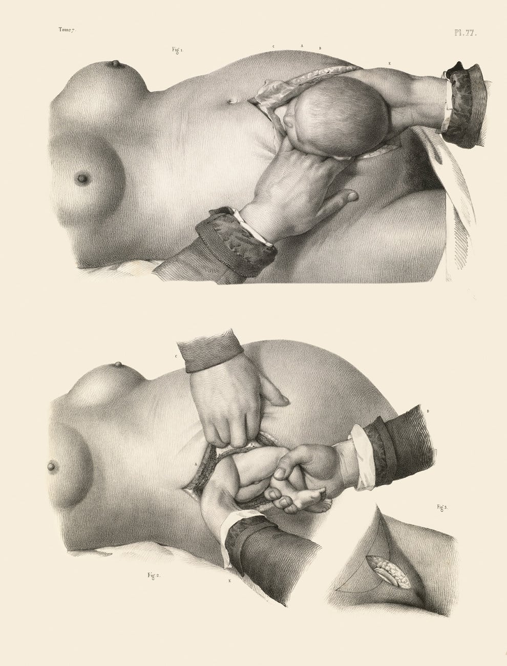 surgery-victorian-era-51