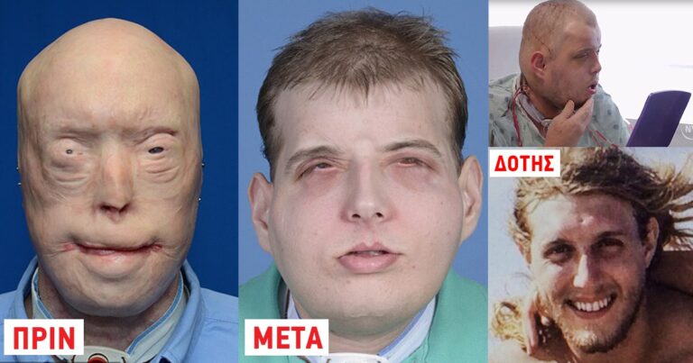 Έγινε η πρώτη και ιστορική ολική μεταμόσχευση σε πρόσωπο πυροσβέστη.