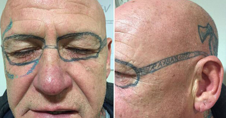 Έγινε «τύφλα» στο μεθύσι & ξύπνησε με τατουάζ… γυαλιά στο πρόσωπο!