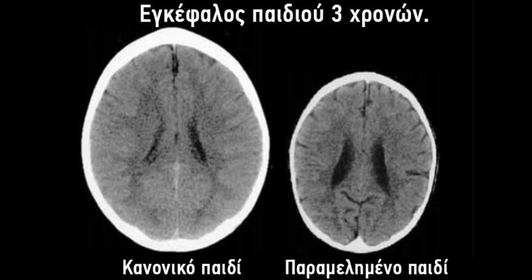 Να τι κάνει η έλλειψης μητρικής αγάπης στον βρεφικό εγκέφαλο!
