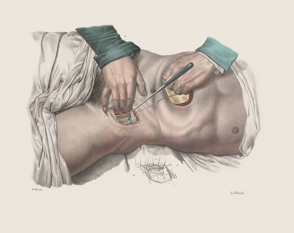 surgery-victorian-era-111