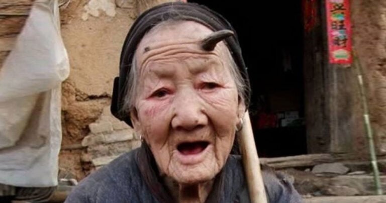 8 άνθρωποι που τους φύτρωσαν αληθινά κέρατα!