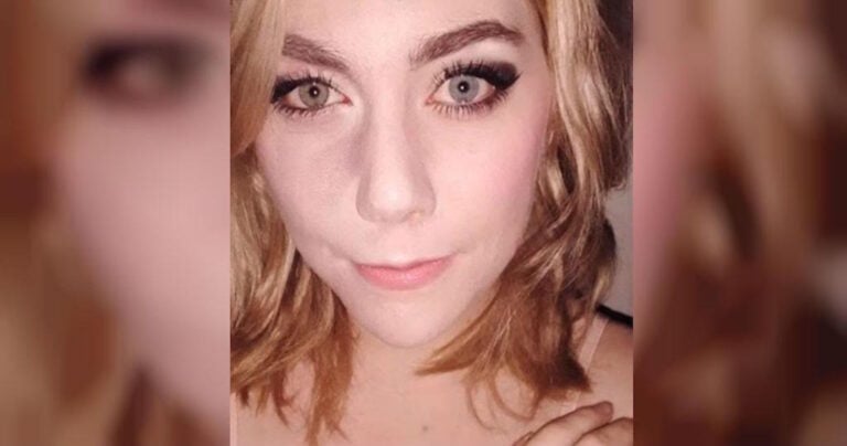 Αυτή η γυναίκα δείχνει με περηφάνια το σημάδι της γέννησής της που έκρυβε για χρόνια.