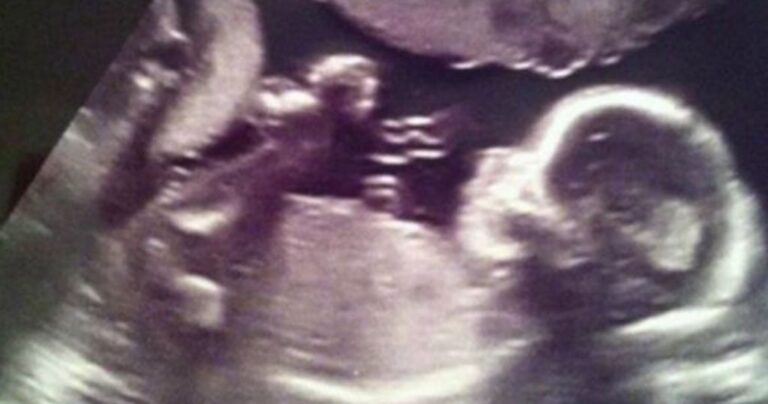 Υπέρηχος δείχνει έναν «άγγελο» να προσέχει την αγέννητη κόρη της.